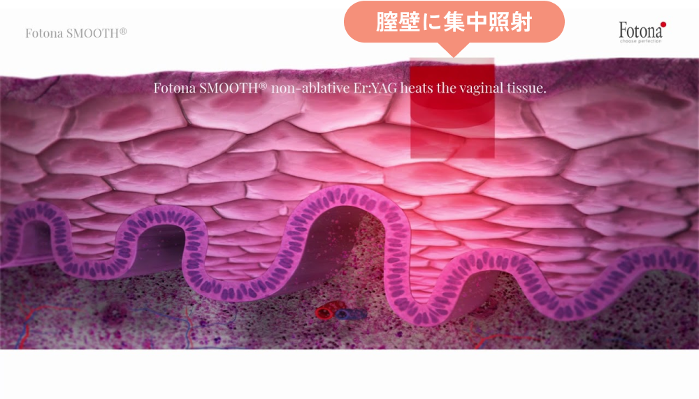 膣壁に集中照射