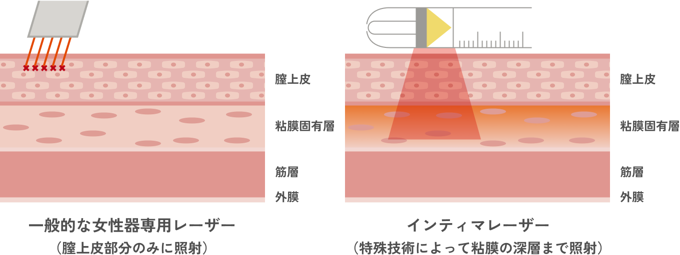 インティマレーザー（尿漏れ・膣の引き締め・外陰部の黒ずみ）の特徴