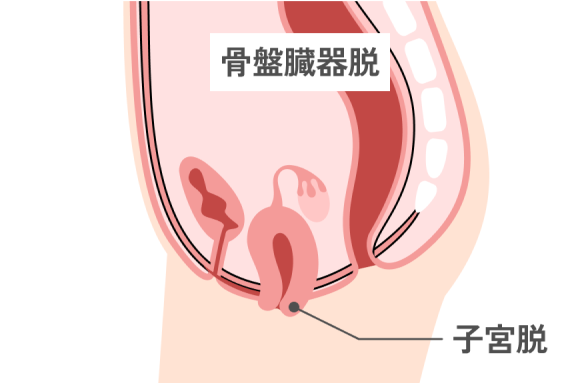 子宮下垂