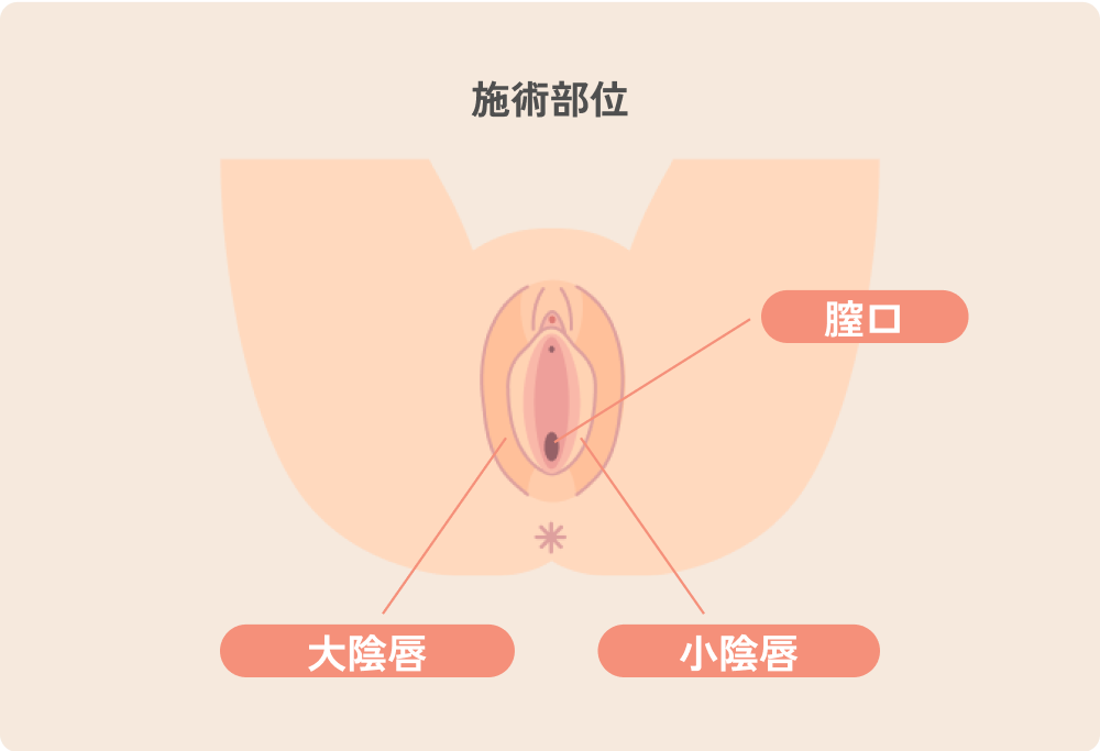 施術部位