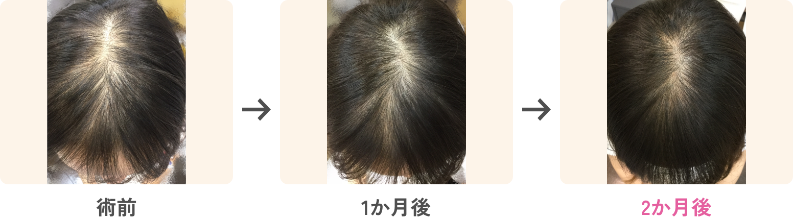 ダウンタイム・治療後から完成までの生活