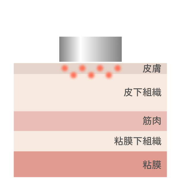 ミラーピール施術イメージ