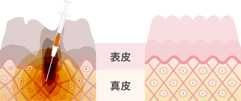 表皮・真皮